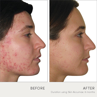 skin accumax results